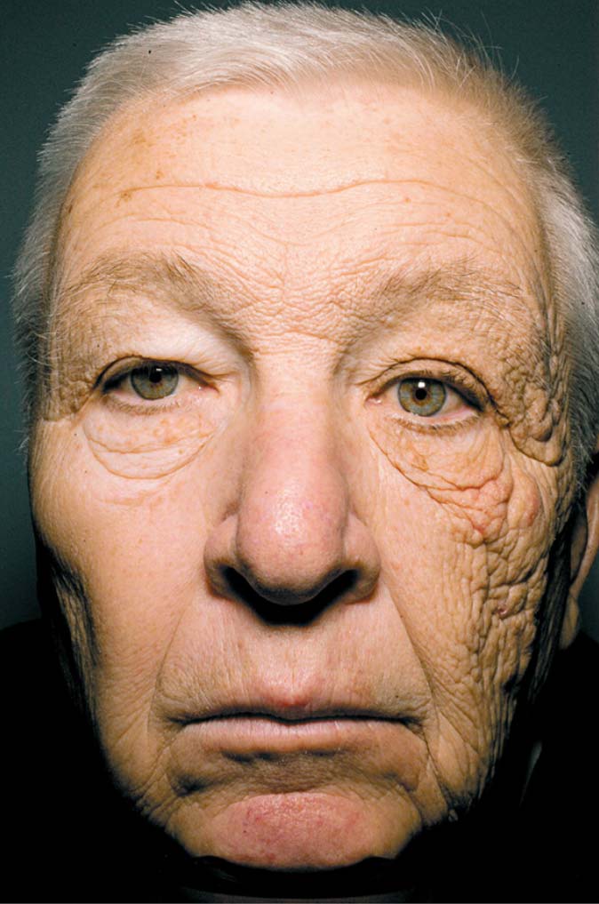 Trucker with sun damaged skin